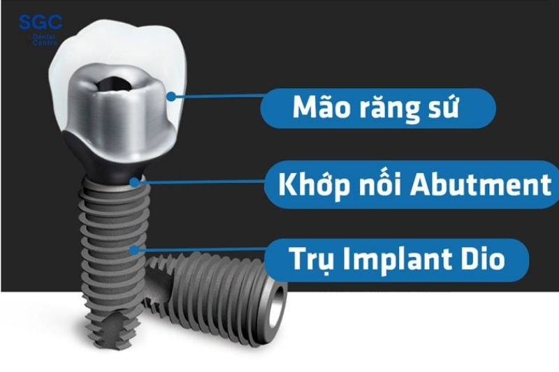 Trụ Implant Dio đem lại khả năng chịu lực vượt trội cho hàm răng