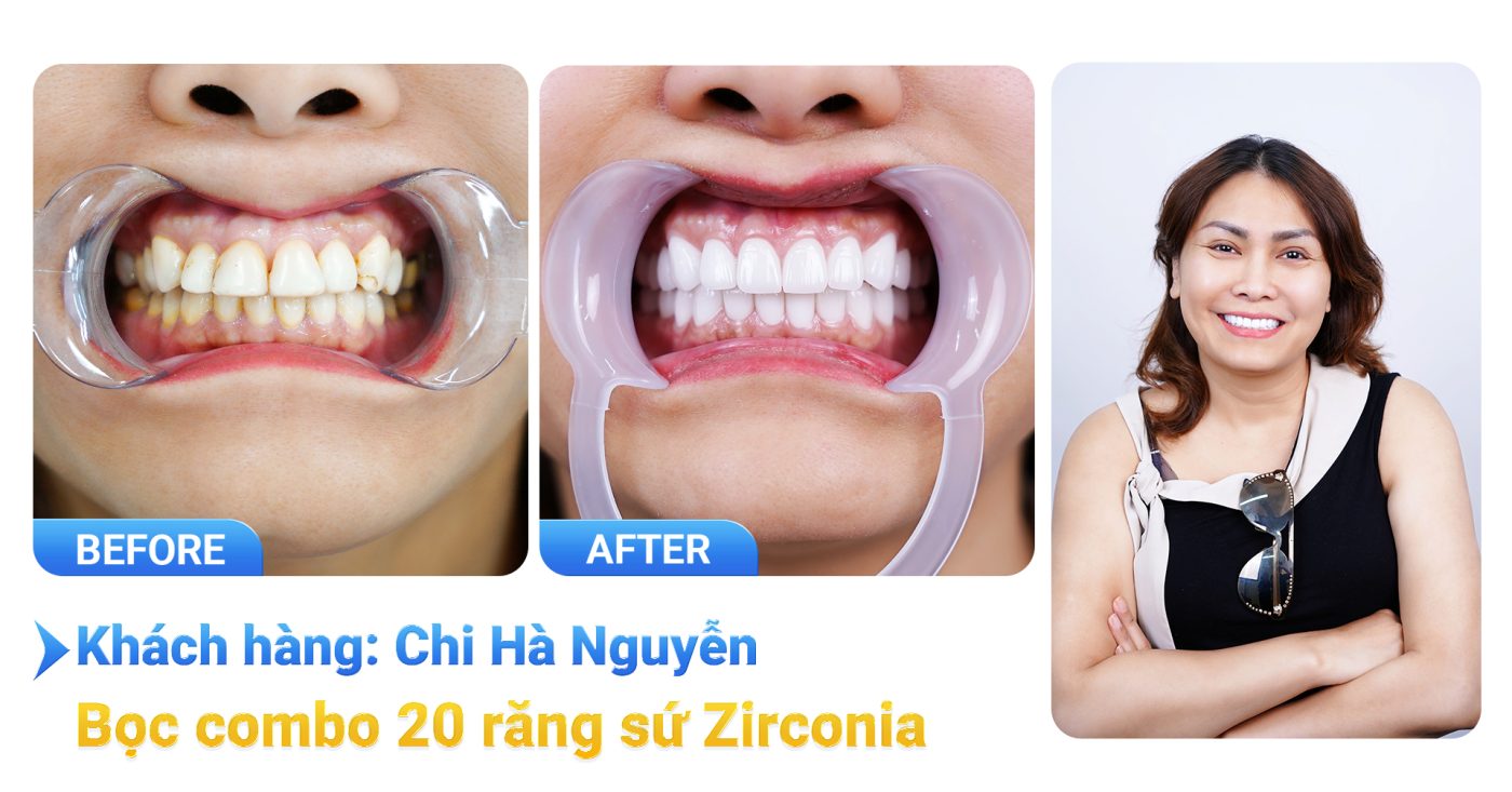 Bọc răng sứ thẩm mỹ là gì? Có tốt không? Bảng giá năm 2025 12 kh chi ha nguyen