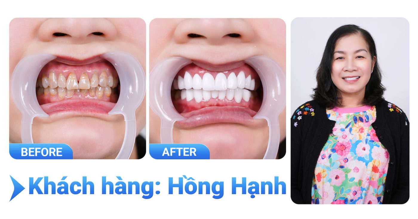 Bọc răng sứ thẩm mỹ là gì? Có tốt không? Bảng giá năm 2025 13 kh chi ha nguyen2