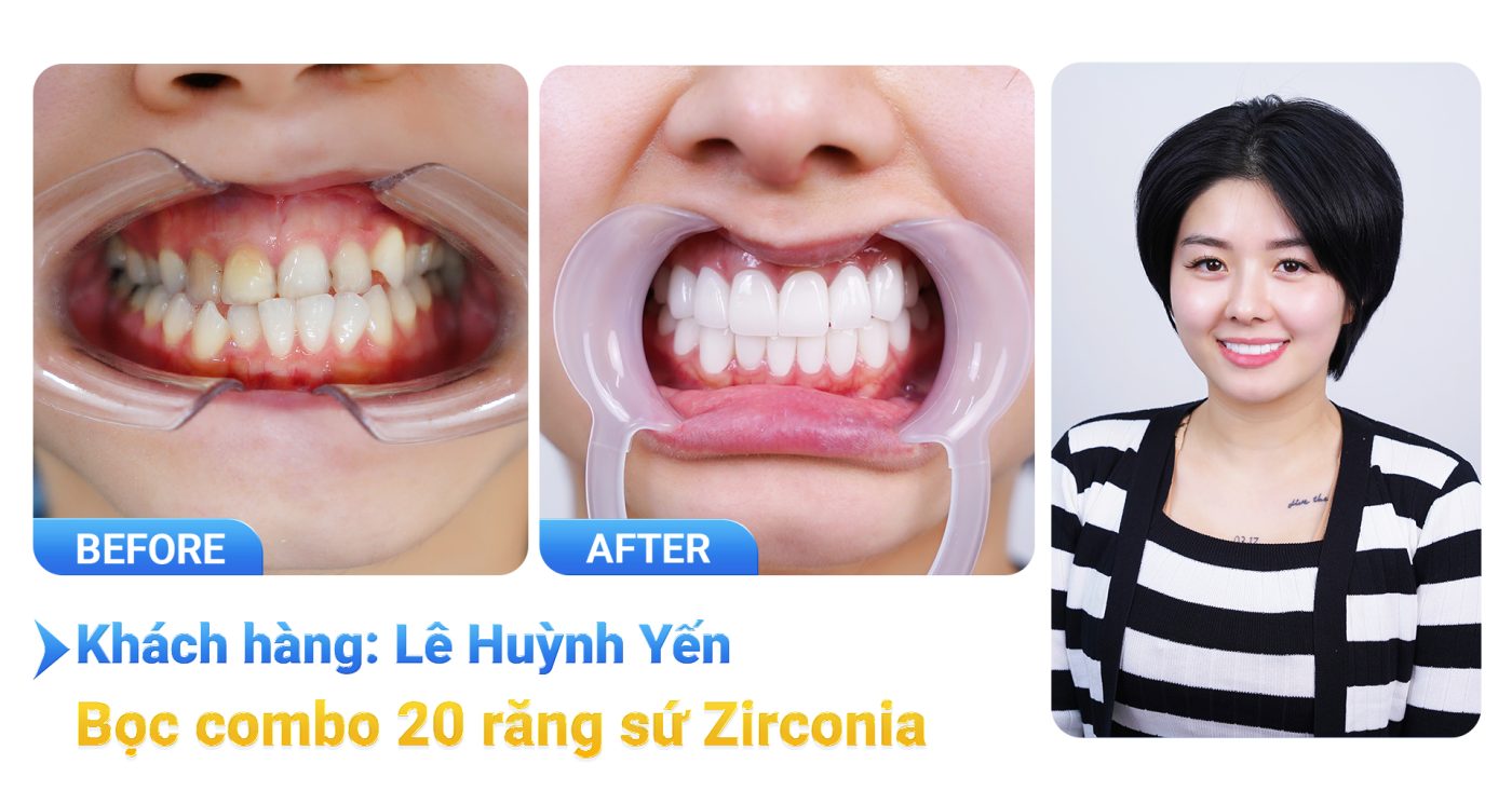 Bọc răng sứ thẩm mỹ là gì? Có tốt không? Bảng giá năm 2025 11 kh le huynh yen