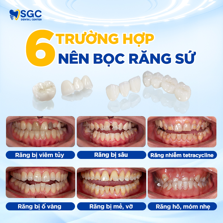Bọc răng sứ thẩm mỹ là gì? Có tốt không? Bảng giá năm 2025 3 6 truong hop boc su 2 1