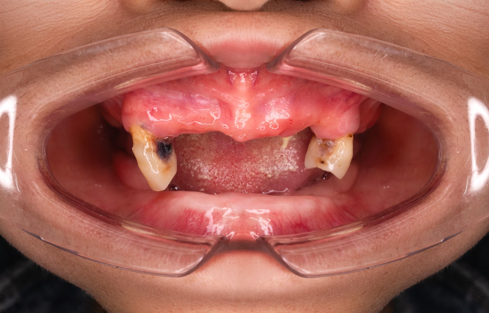 Trồng răng Implant 5 1 8