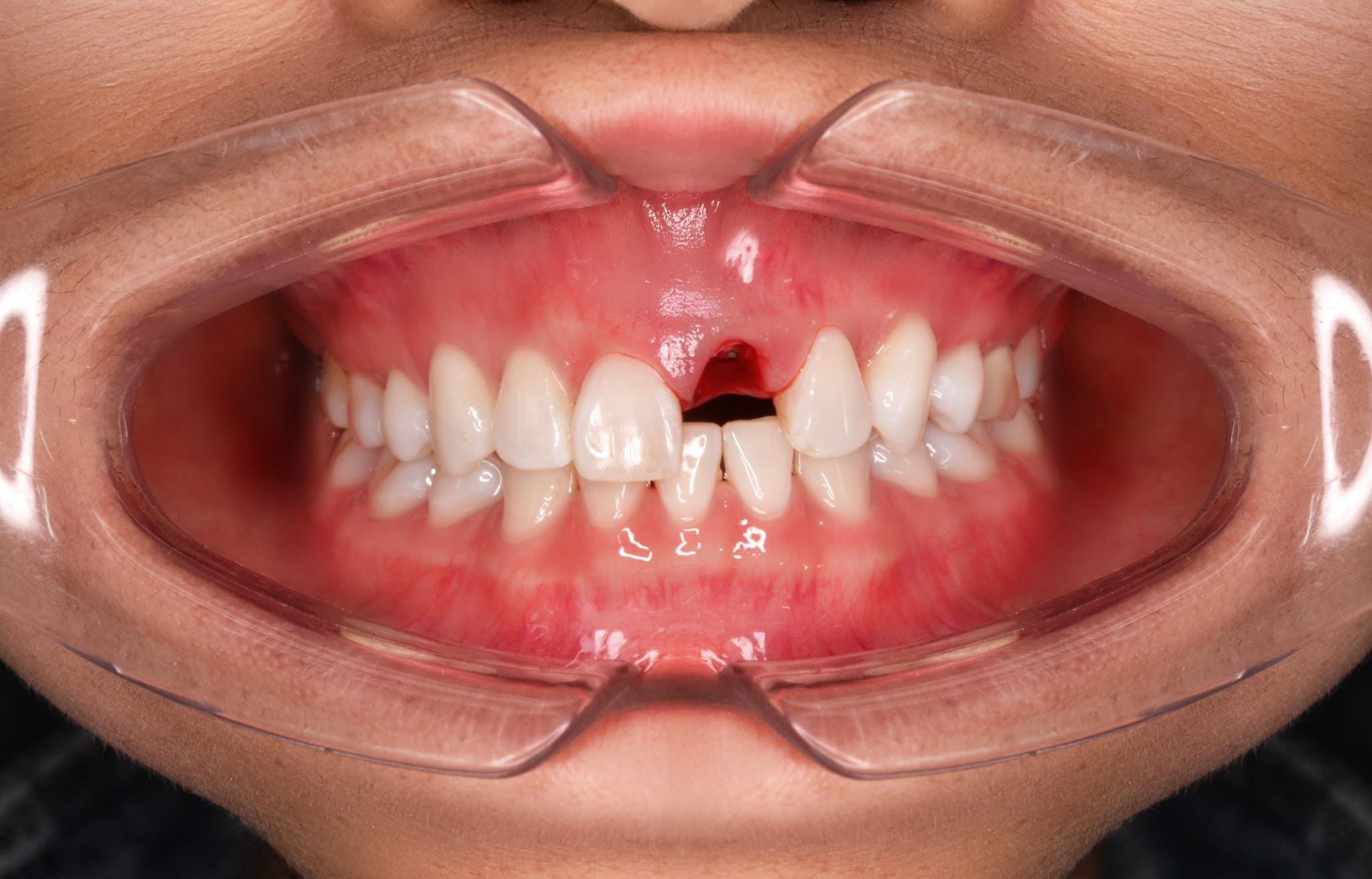 Trồng răng Implant 4 2 9