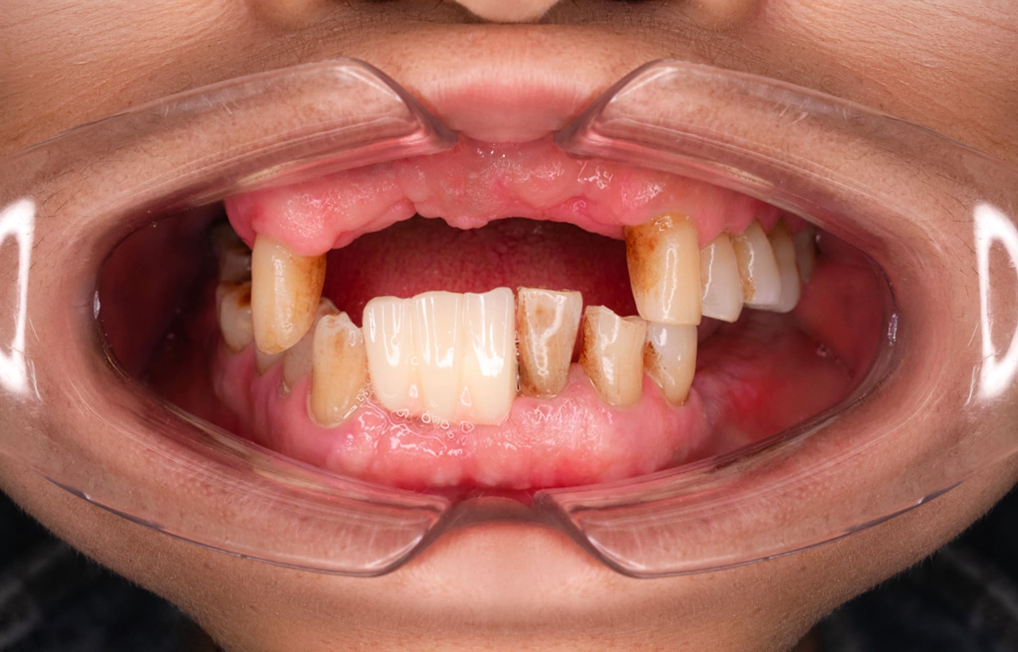 Trồng răng Implant 6 3 9