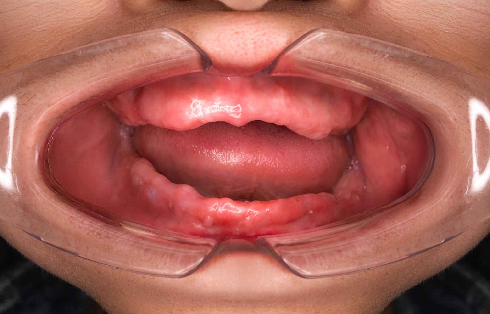 Trồng răng Implant 7 4 4