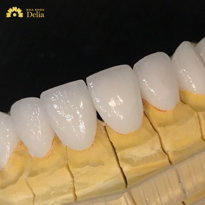Bọc răng sứ thẩm mỹ 18 4f9cc7046824e252a5147249c02f1e29