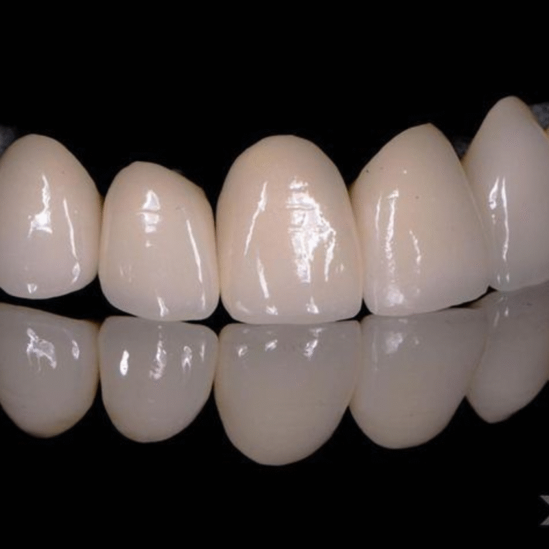 Bọc răng sứ thẩm mỹ 23 Cercon 1