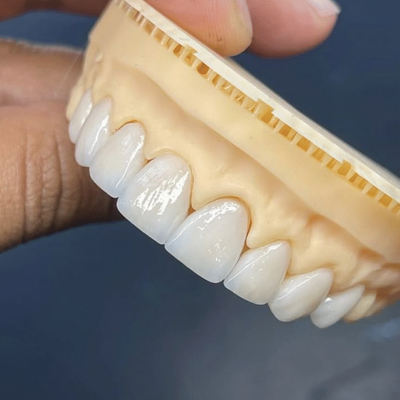 Bọc răng sứ thẩm mỹ 27 Cercon 2