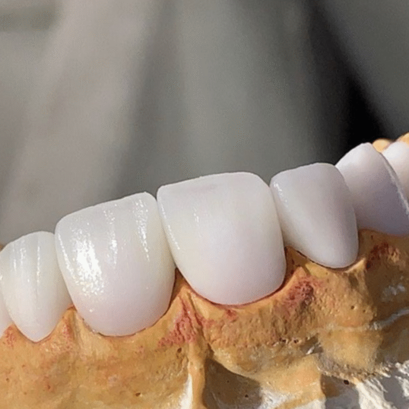 Bọc răng sứ thẩm mỹ 29 Cercon 3