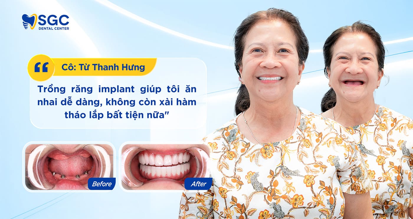 Trồng răng Implant 31 Co Tu Thanh Hung
