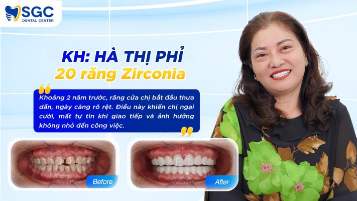 làm 20 răng sứ ziconia CHỊ HÀ THỊ PHỈ