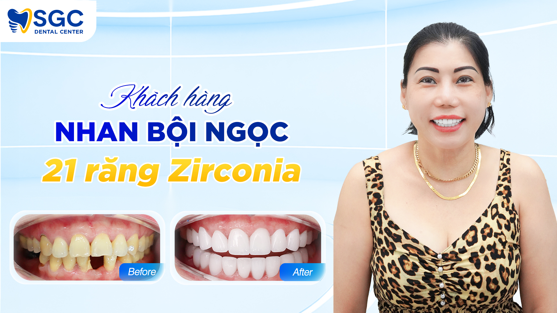 Chị bội ngọc làm 20 răng sứ zirconia