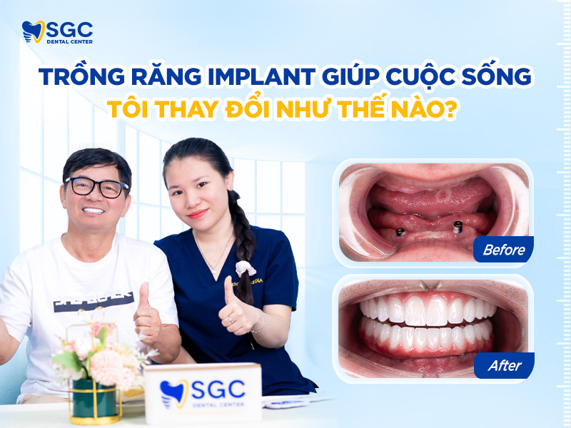 Trồng răng Implant 30 TRONG RANG IMPLANT THAY DOI TOI NHU THE NAO