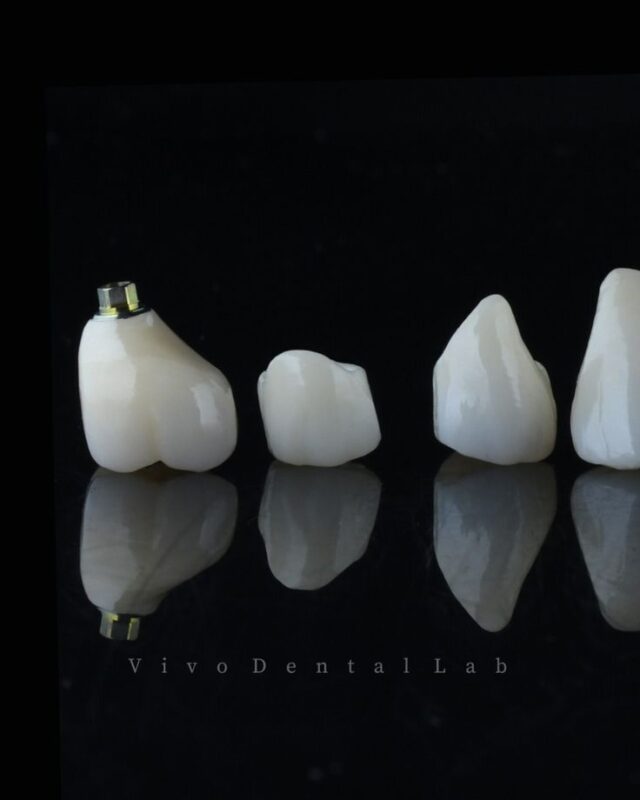 Bọc răng sứ thẩm mỹ 26 bb3edfae98d70a608a75871c7fec60f3