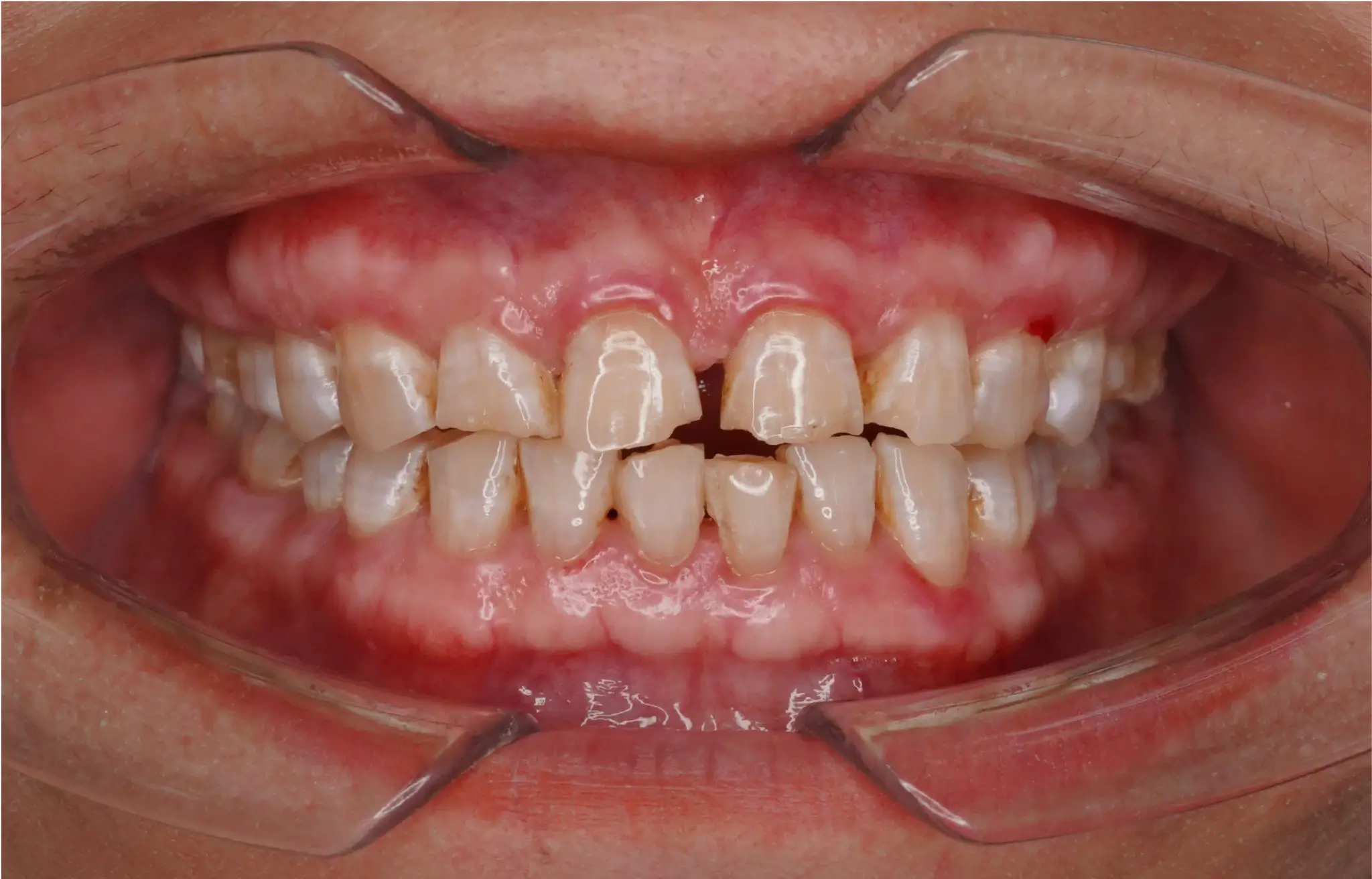 Bọc răng sứ thẩm mỹ 3 rang bi nut