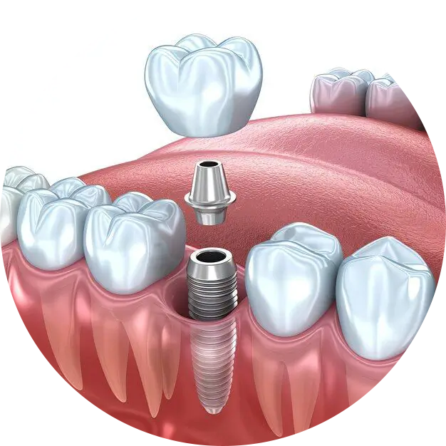 Trồng răng Implant 2 rang implant