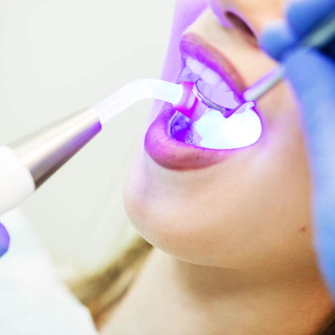 Trám răng 13 Chiếu đèn quang trùng hợp (LED curing light) rồi chỉnh khớp