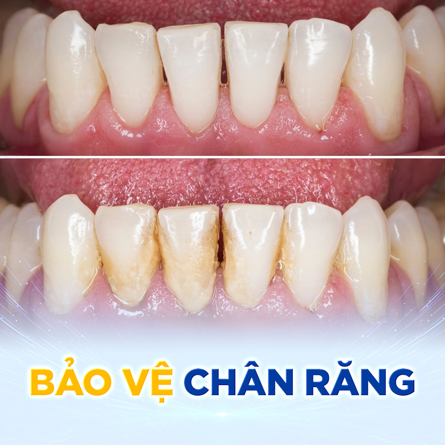 bao ve chan rang