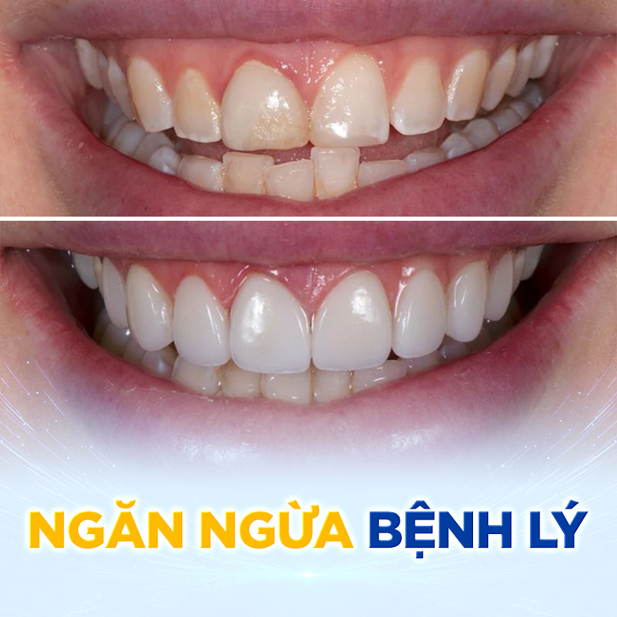 ngan ngua benh li