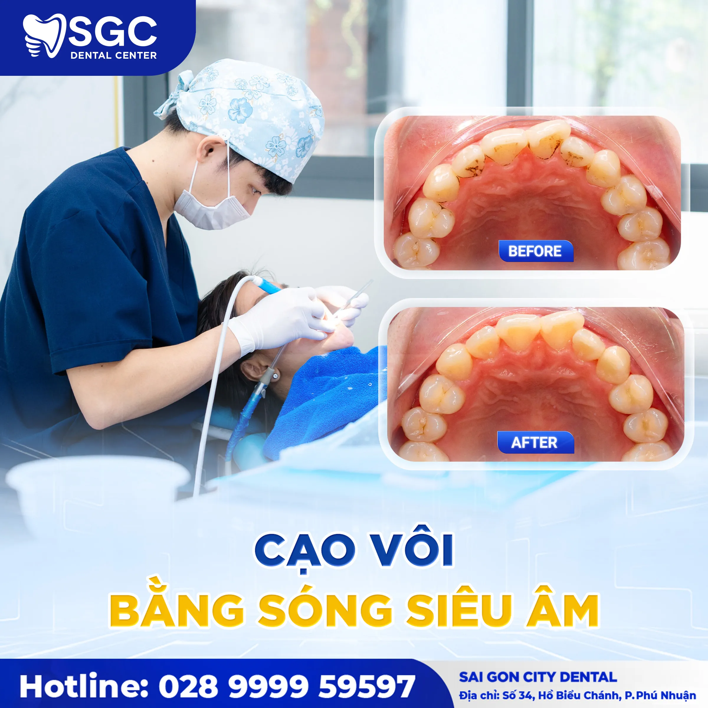 cao voi rang mien phi