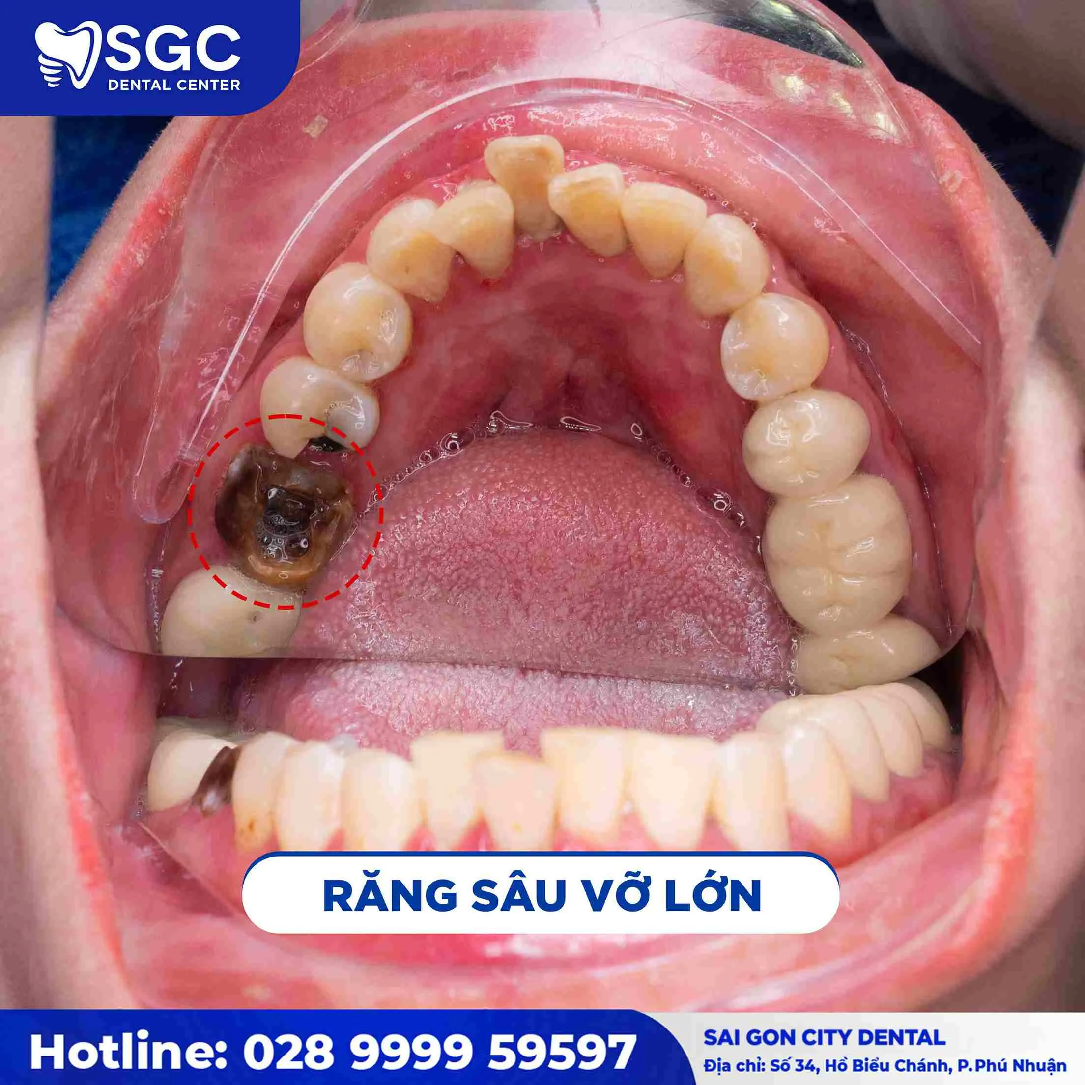 Trám răng 7 Sau Trám răng sâu