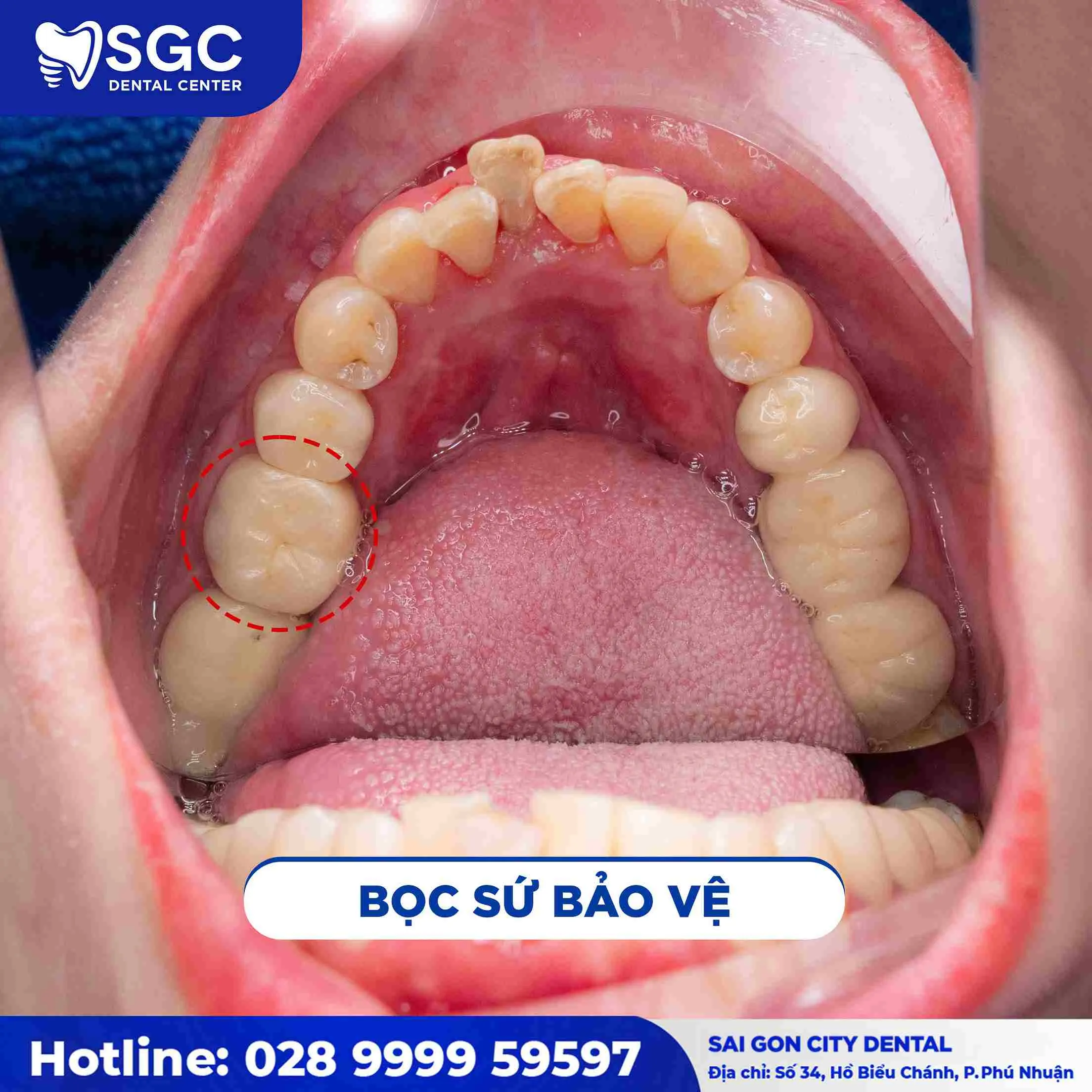 Trám răng 6 Sau Trám Răng