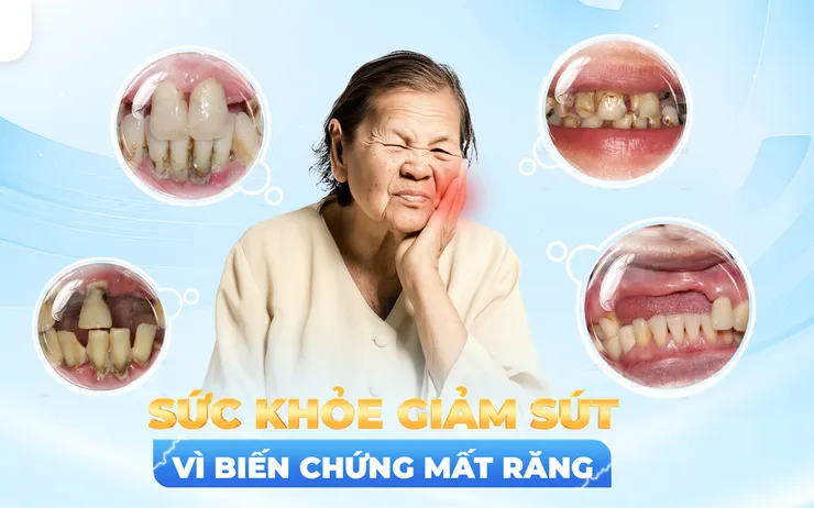 vì sao nên trồng răng implant