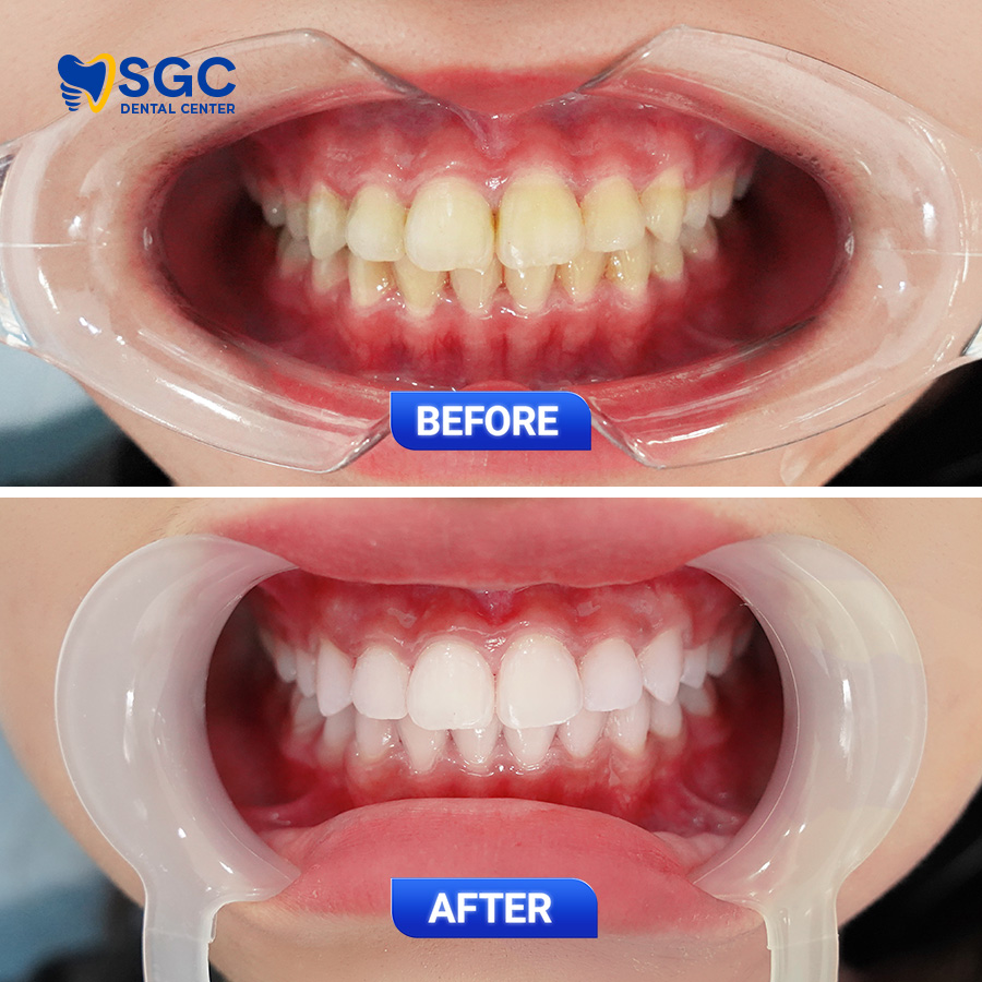 Tẩy trắng răng 4 BF AF