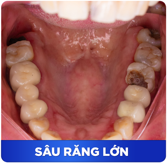 Điều trị tủy răng 5 SAU RANG