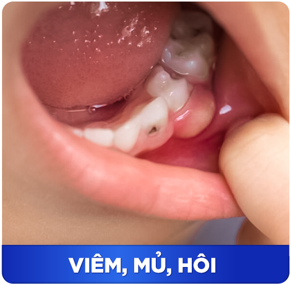 Điều trị tủy răng 6 VIEM MU HOI