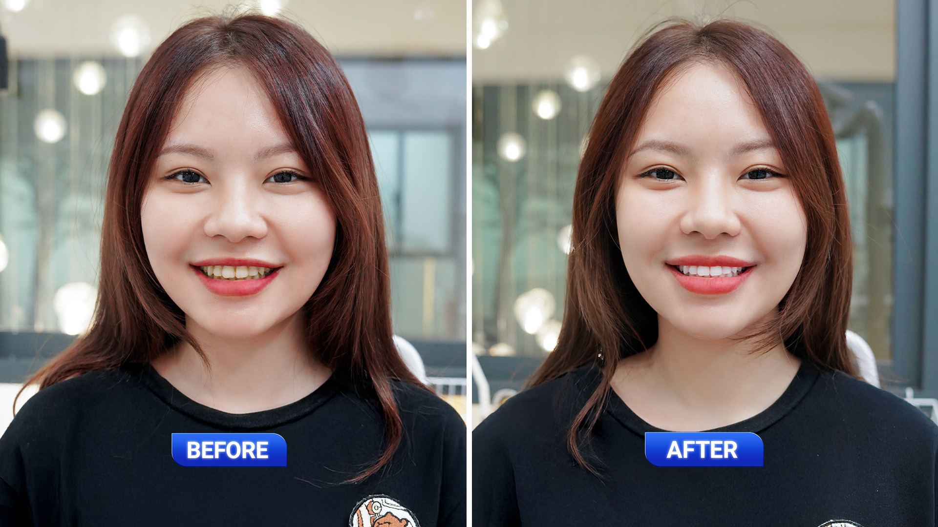 Tẩy trắng răng 3 tay trang