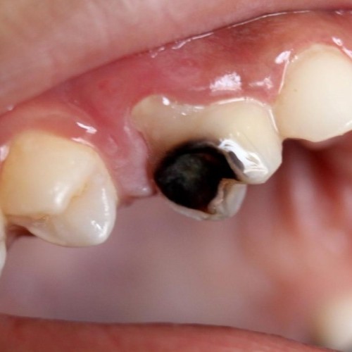 Điều trị tủy răng 6 tram rang sau lo to bao nhieu tien 1