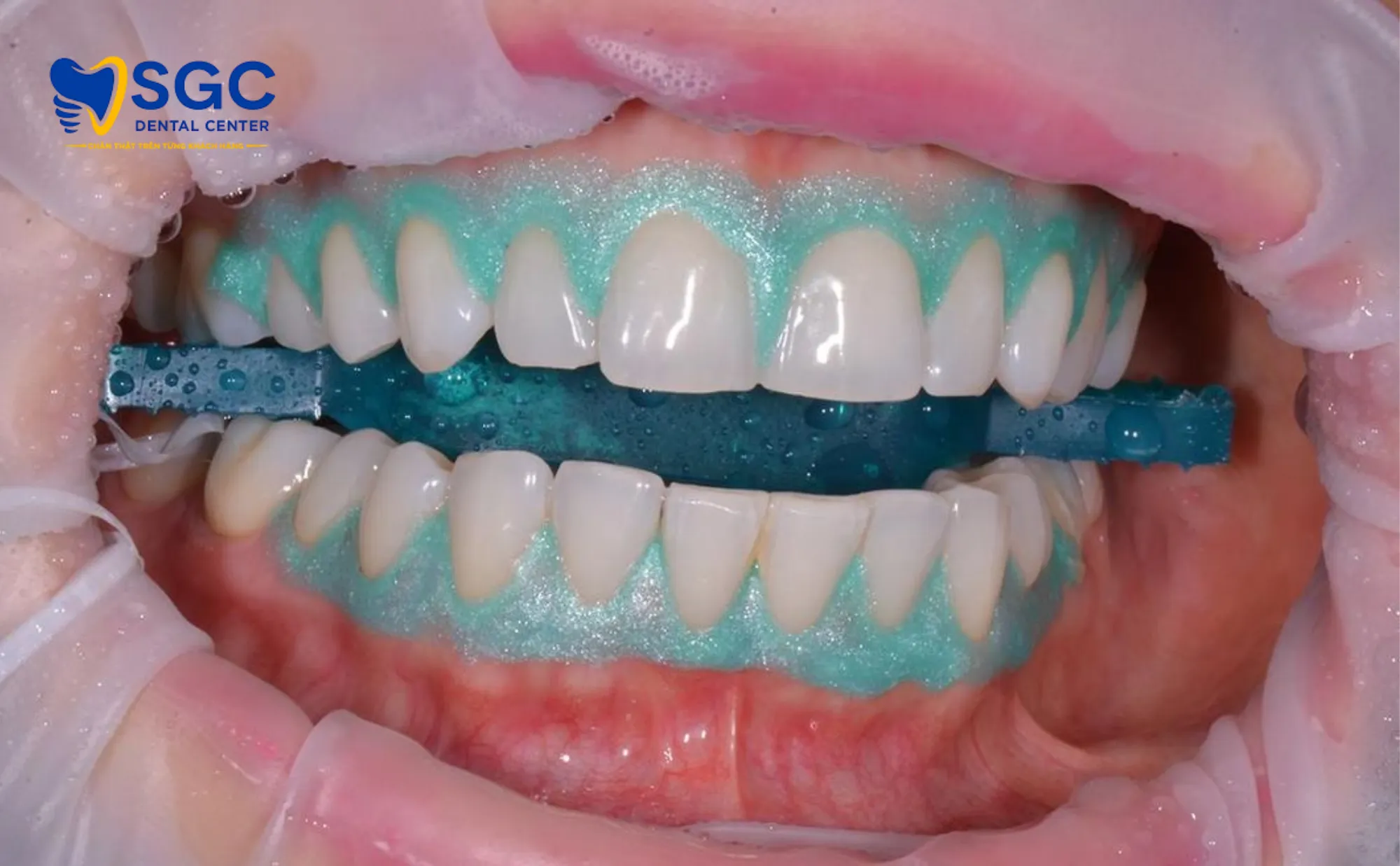 cach-ly-nuou-tay-trang-rang