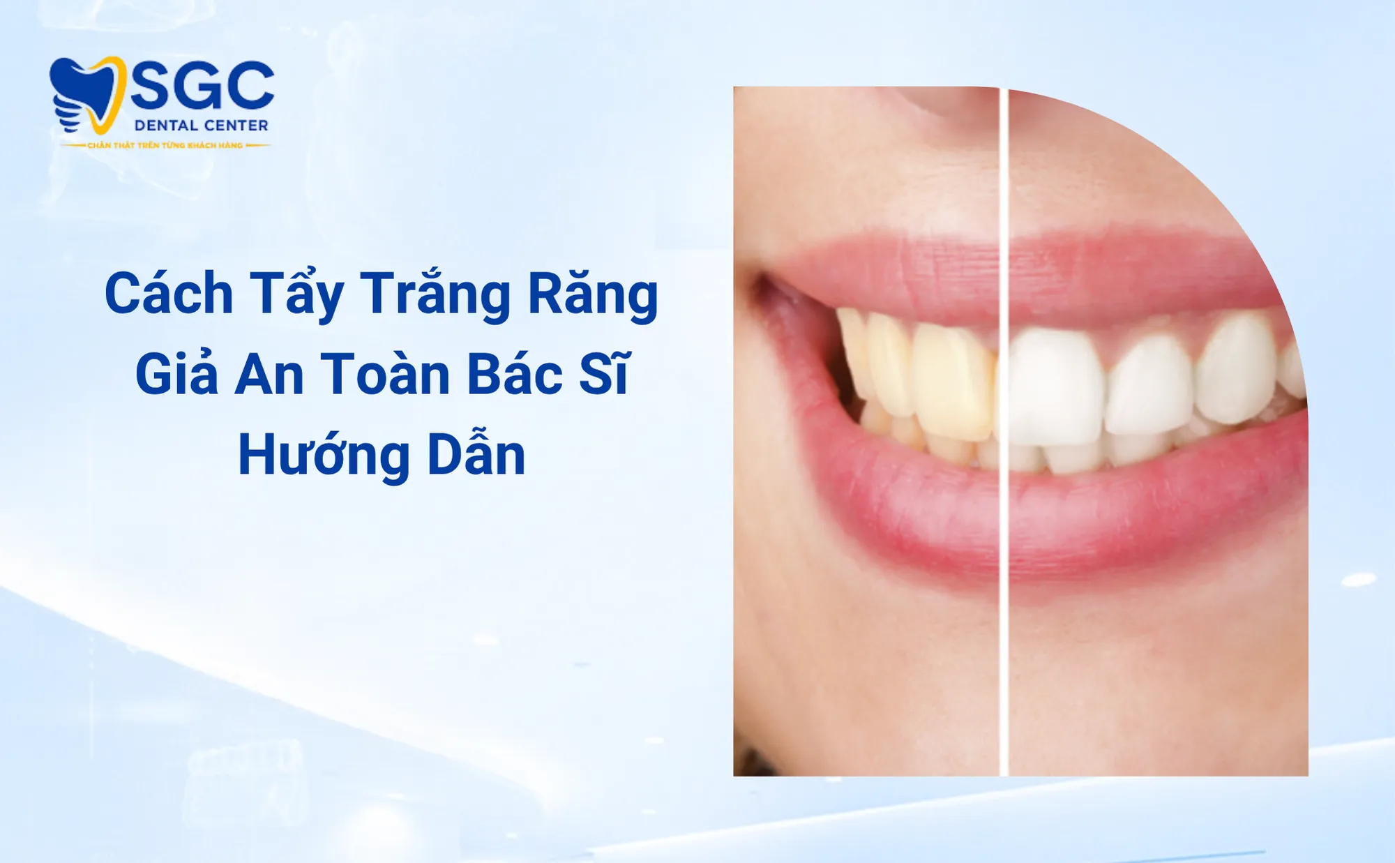 Cách Tẩy Trắng Răng Giả An Toàn Bác Sĩ Hướng Dẫn