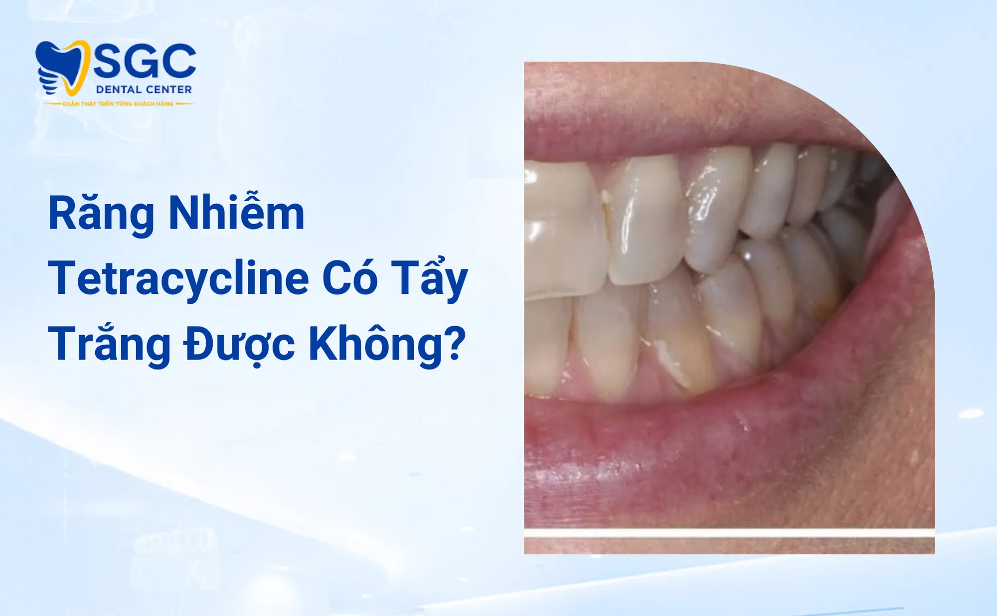 Răng Nhiễm Tetracycline Có Tẩy Trắng Được Không Bác Sĩ Đáp