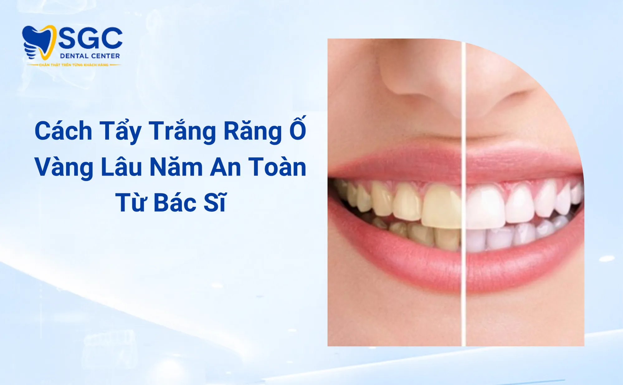 Cách Tẩy Trắng Răng Ố Vàng Lâu Năm An Toàn Từ Bác Sĩ