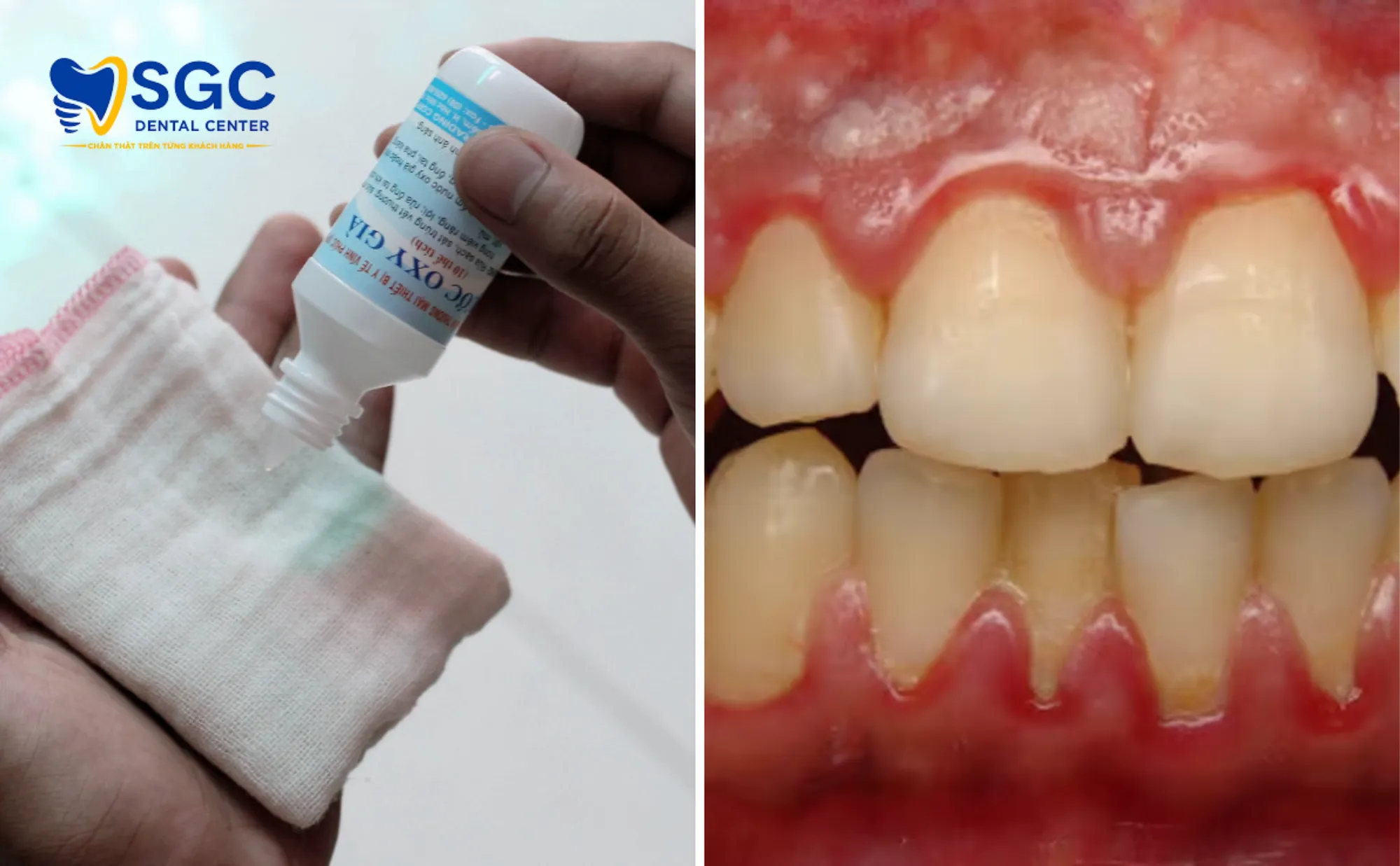 canh-bao-hoa-chat-oxy-gia