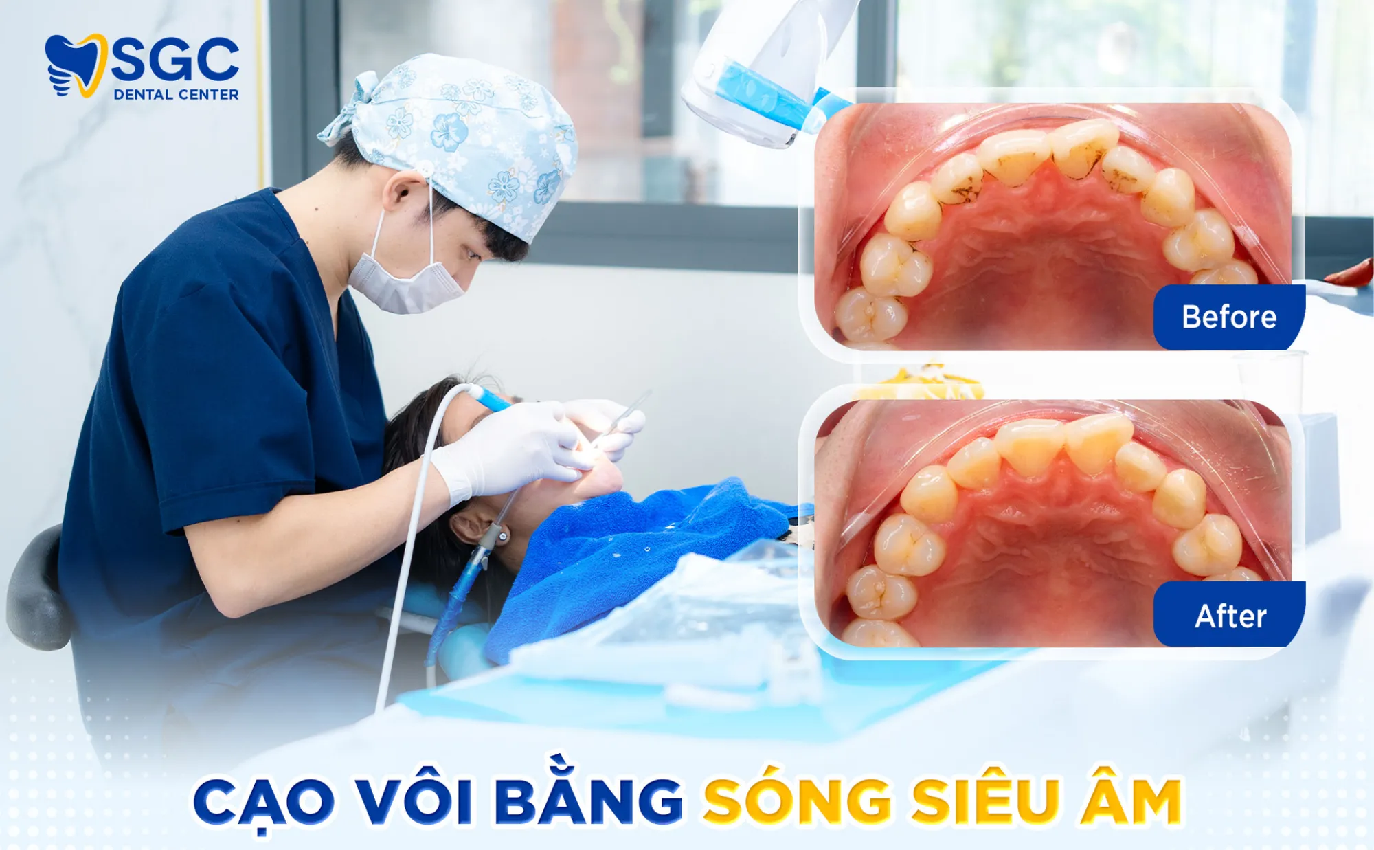 cao-voi-rang-sieu-am