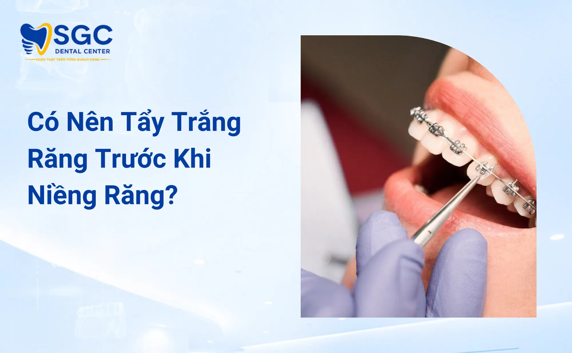 Có Nên Tẩy Trắng Răng Trước Khi Niềng Răng Thời Điểm Vàng