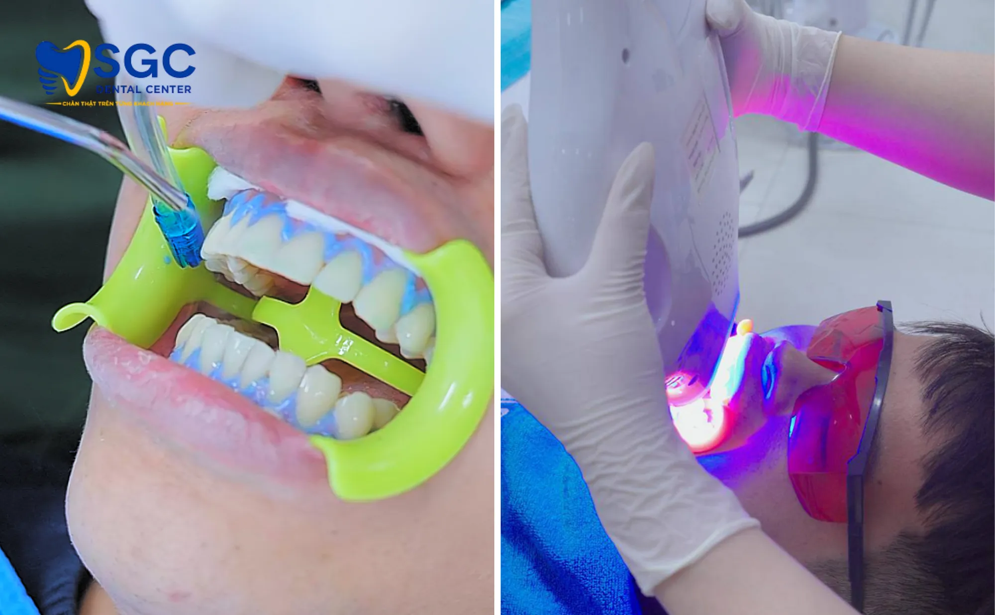 cong-nghe-dual-laser-sgc