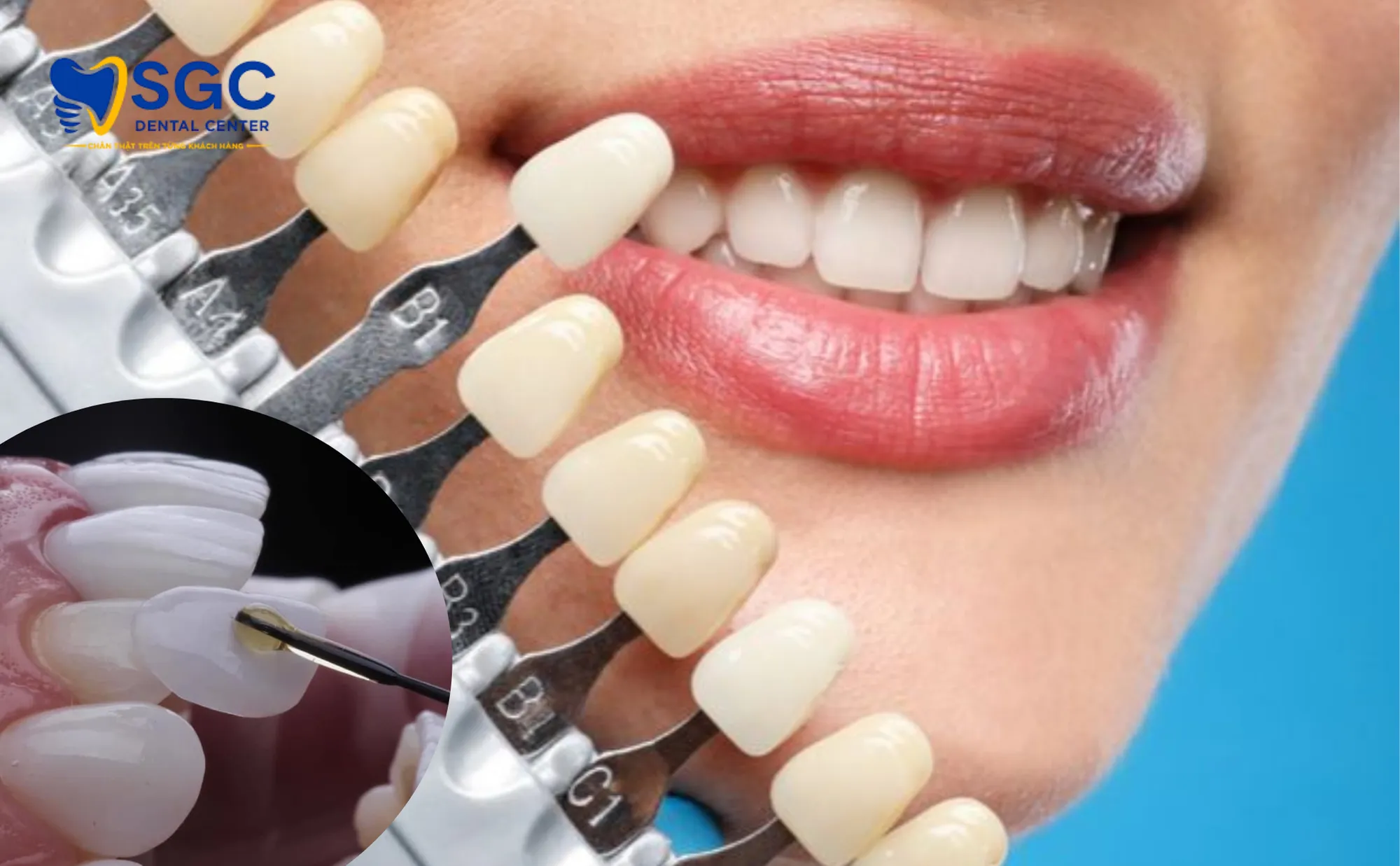 dan-su-veneer-rang-nhiem-mau