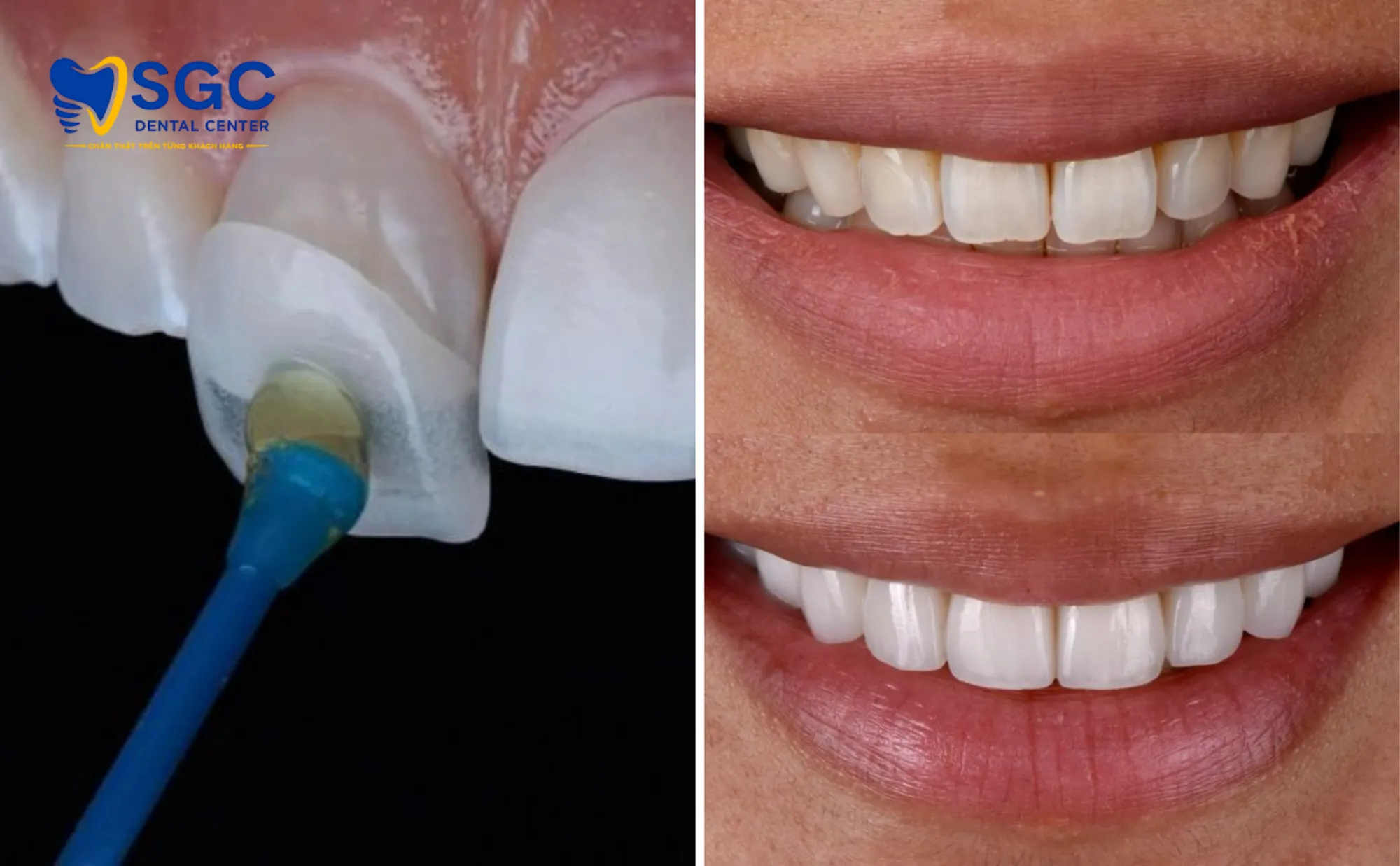 dan-su-veneer-rang-vang