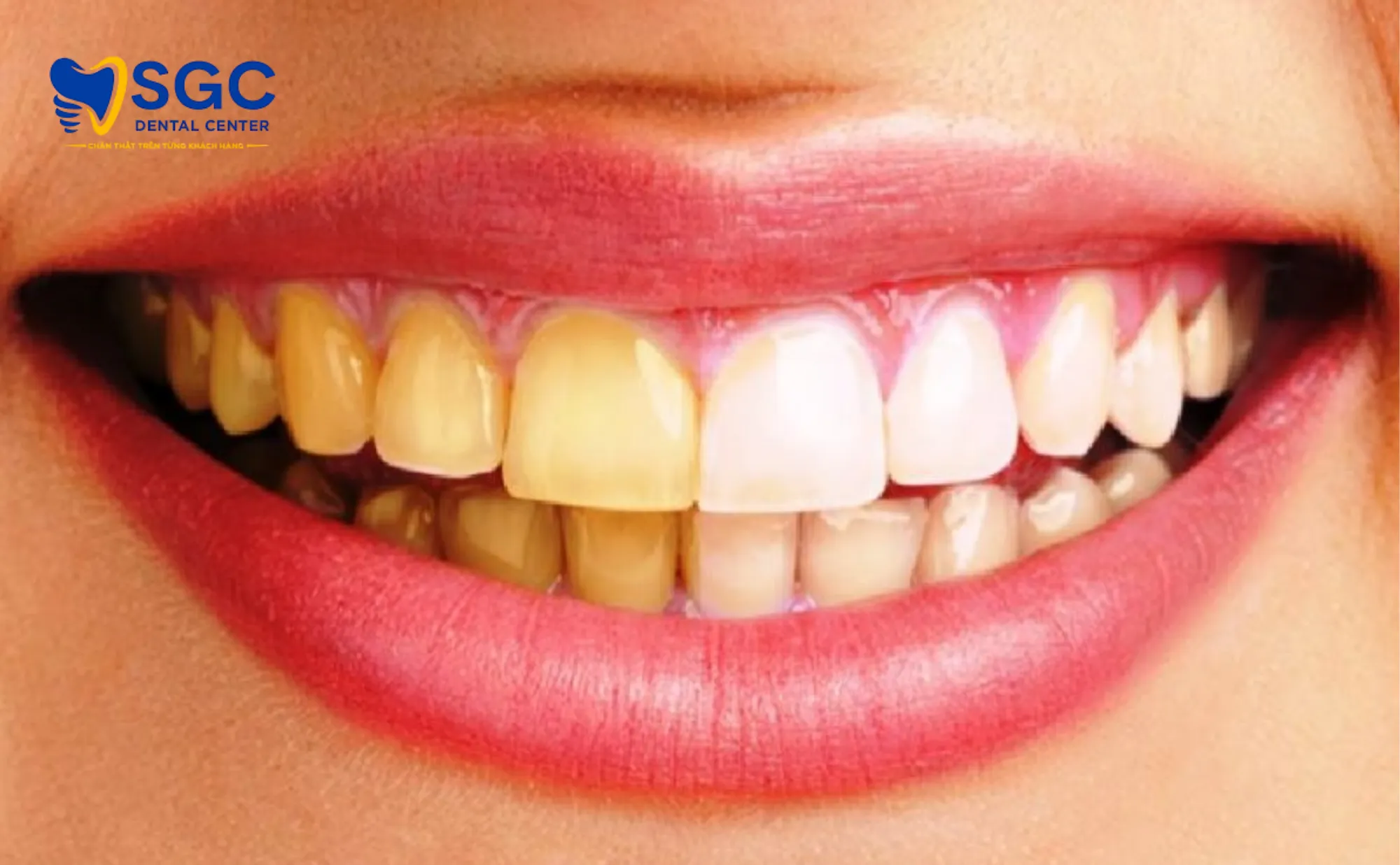 nguyen-nhan-rang-su-o-vang