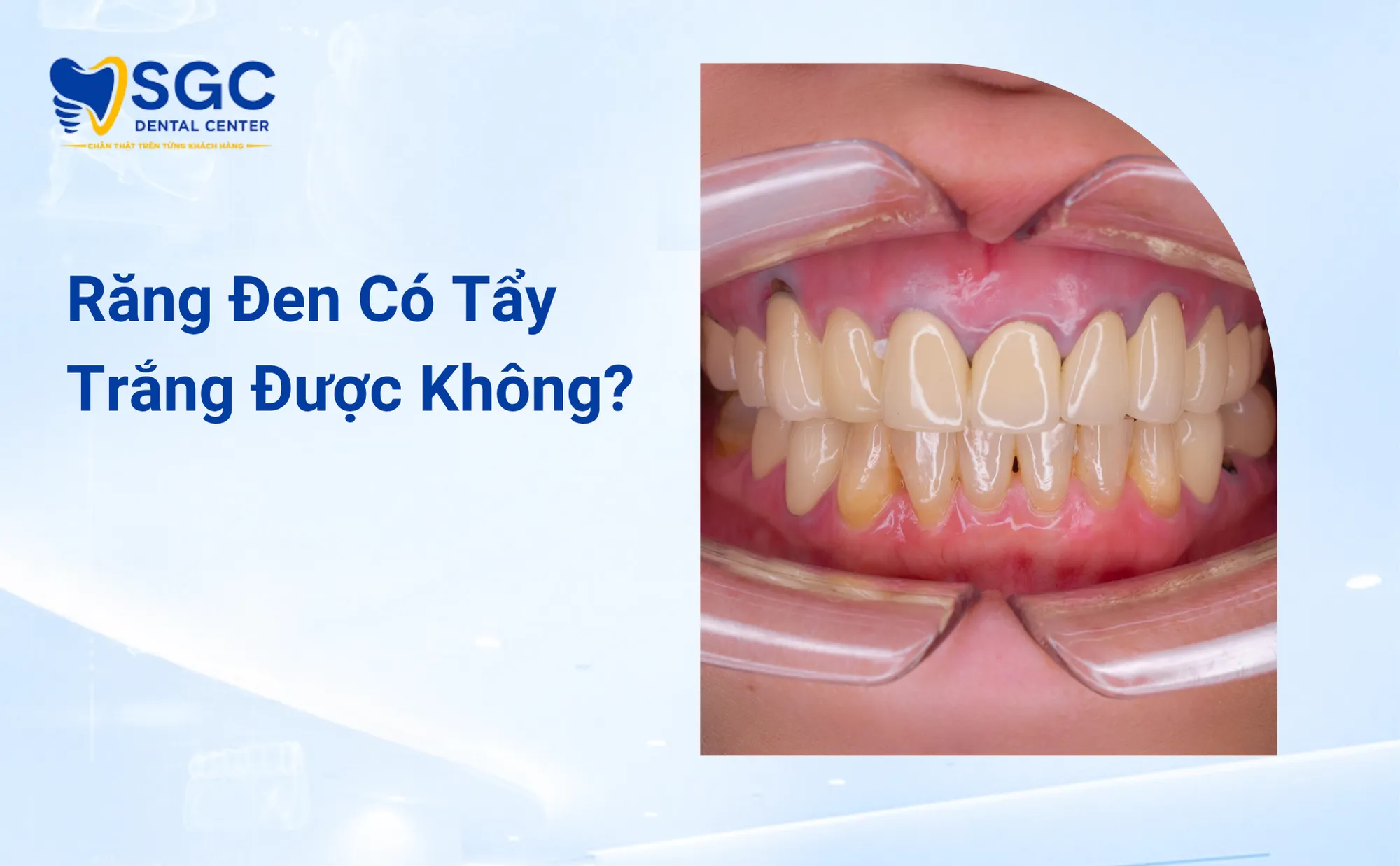 Răng Đen Có Tẩy Trắng Được Không Bác Sĩ Chẩn Đoán