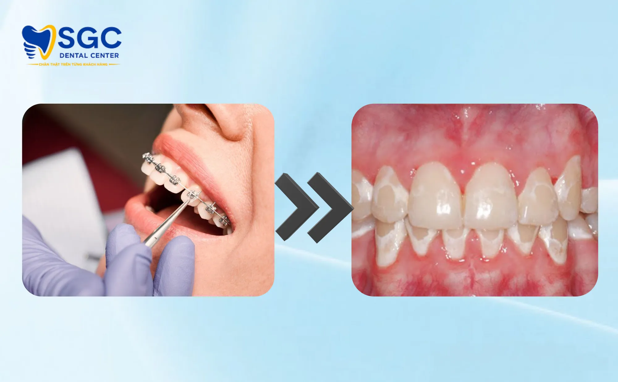 rang-loang-lo-sau-thao-nieng