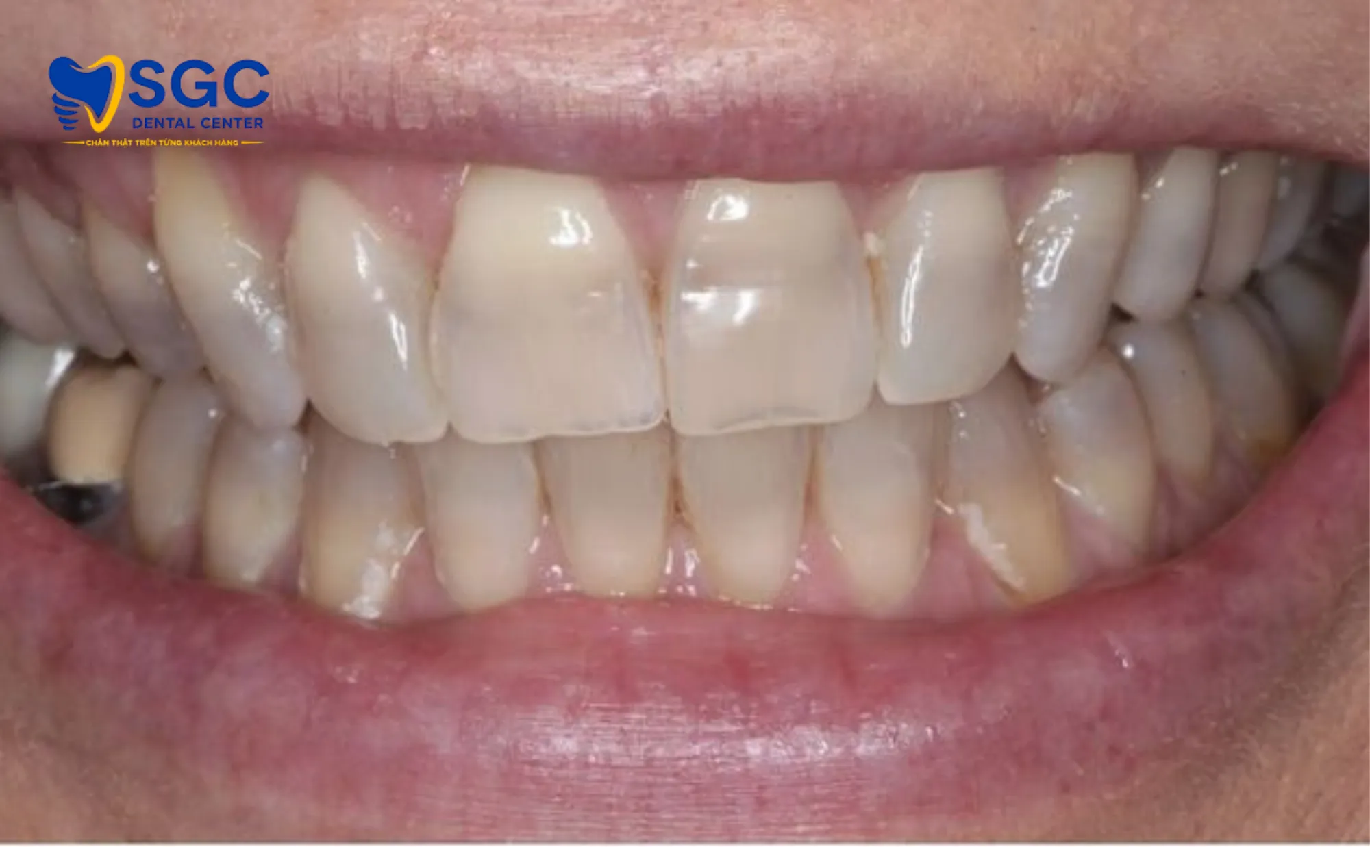 rang-nhiem-tetracycline-nhe