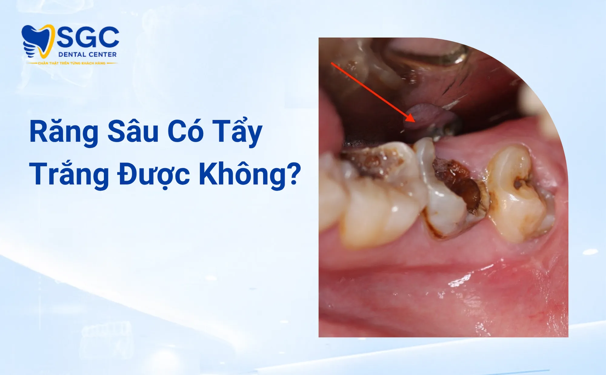 Răng Sâu Có Tẩy Trắng Được Không Bác Sĩ Cảnh Báo