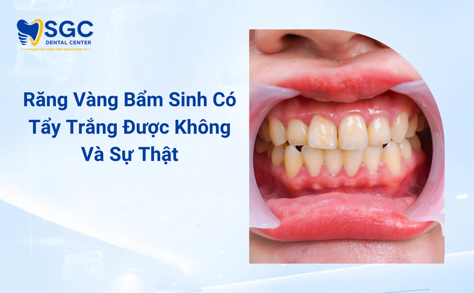 Răng Vàng Bẩm Sinh Có Tẩy Trắng Được Không Và Sự Thật