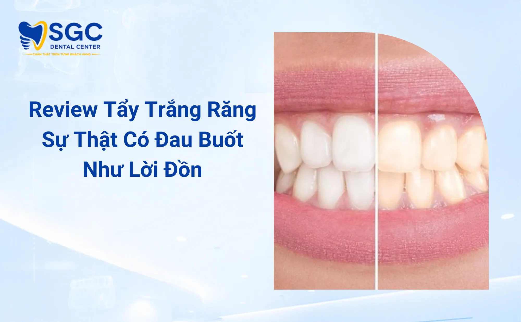 Review Tẩy Trắng Răng Sự Thật Có Đau Buốt Như Lời Đồn