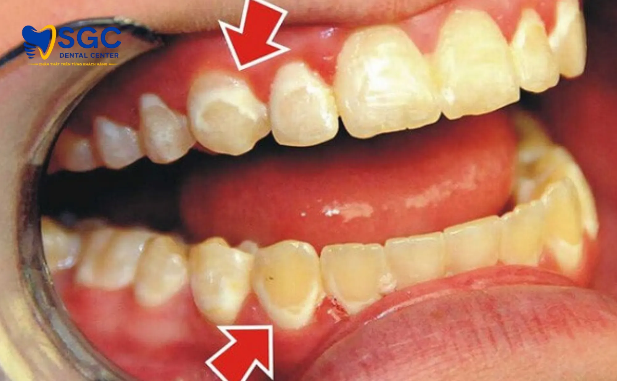 tac-hai-cua-tay-trang-rang